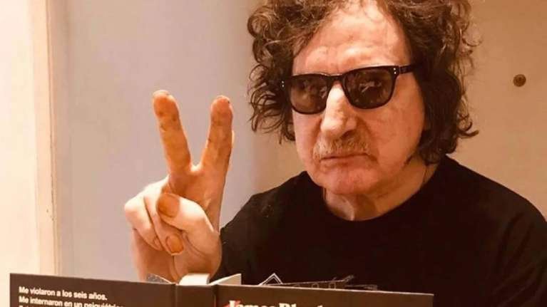 Charly García sufrió una quemadura